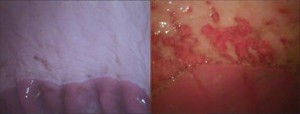 Healthy-stomach-compared-to-gastric-ulcerations-300x114