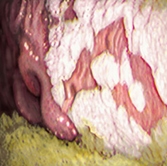 Grade3Ulcer